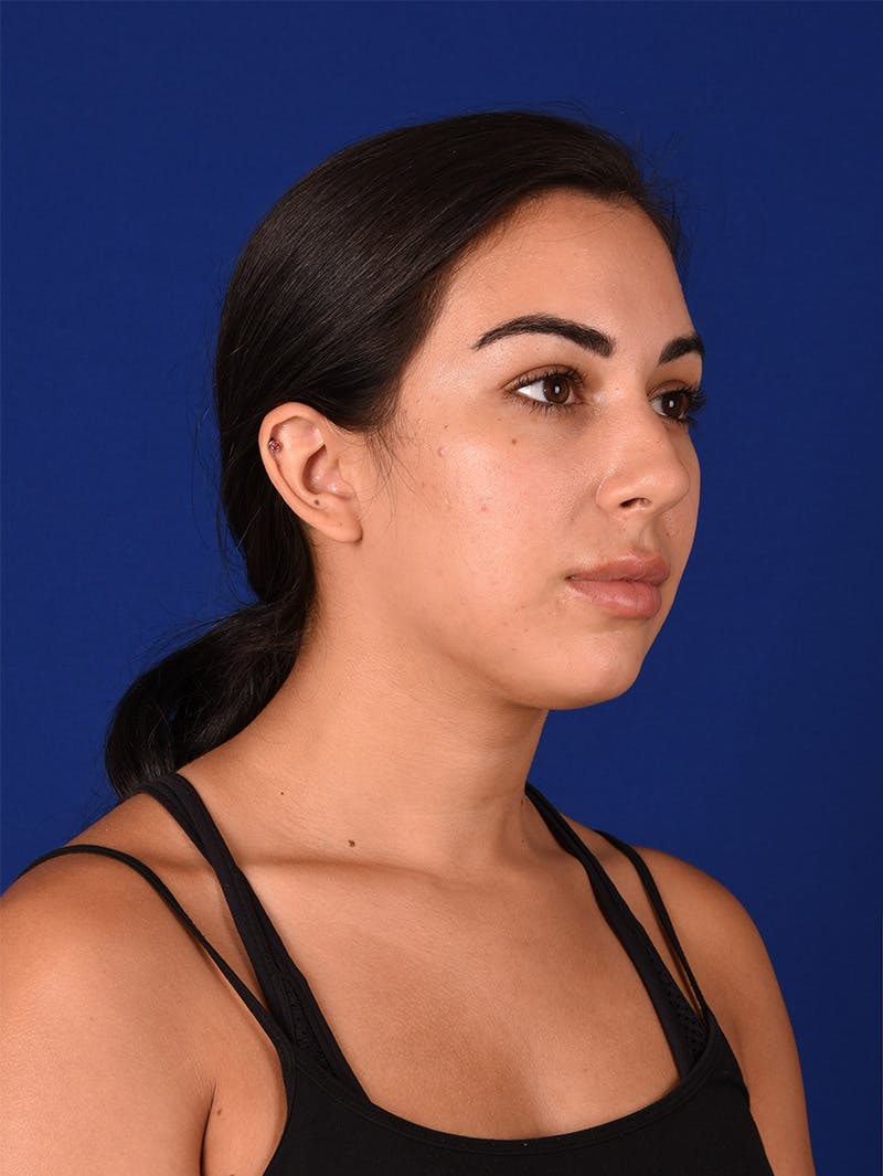 Female Rhinoplasty Before & After Gallery - Patient 115978323 - Image 3