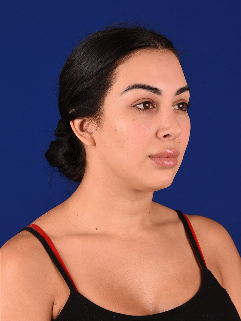 Female Rhinoplasty Before & After Gallery - Patient 115978323 - Image 4