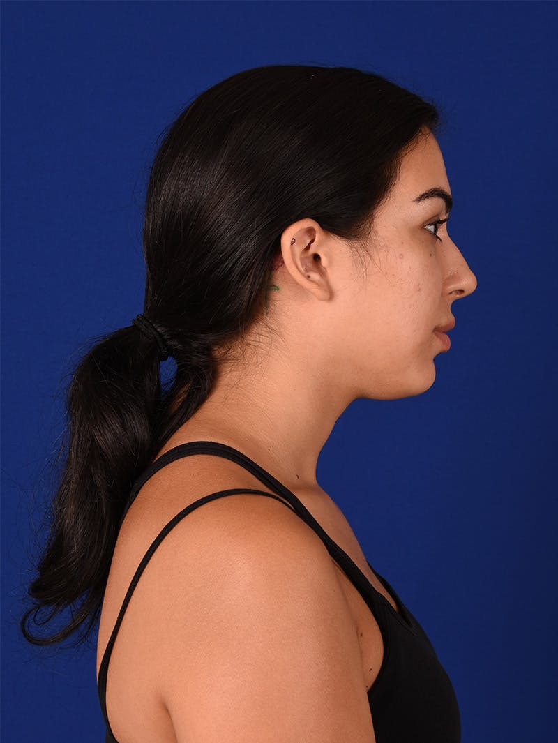 Female Rhinoplasty Before & After Gallery - Patient 115978323 - Image 5