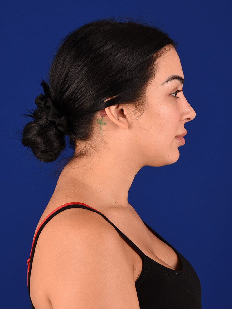 Female Rhinoplasty Before & After Gallery - Patient 115978323 - Image 6