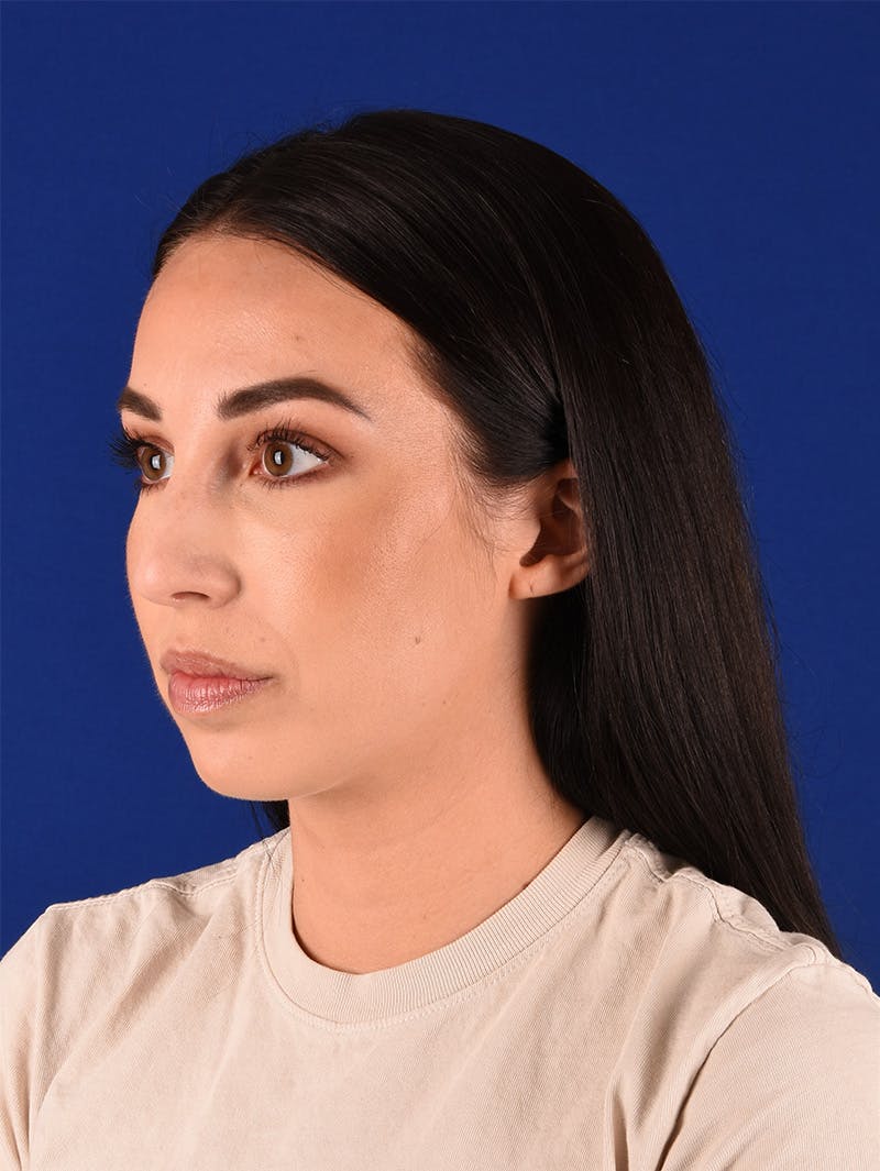 Female Rhinoplasty Before & After Gallery - Patient 115978462 - Image 3