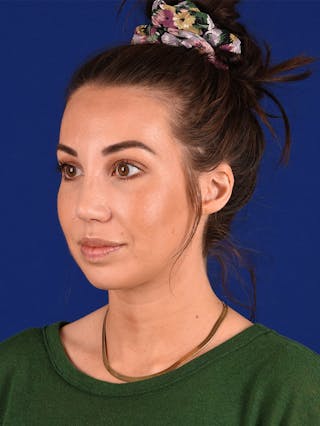 Female Rhinoplasty Before & After Gallery - Patient 115978462 - Image 4