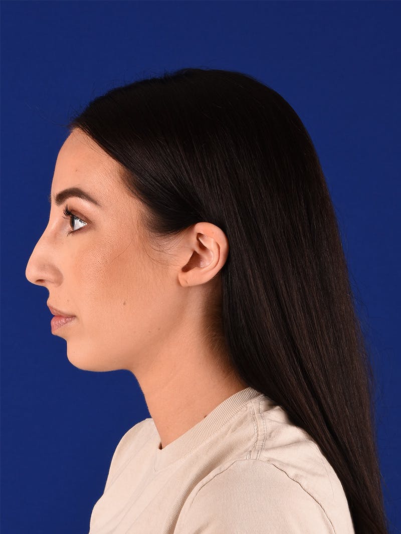 Female Rhinoplasty Before & After Gallery - Patient 115978462 - Image 5