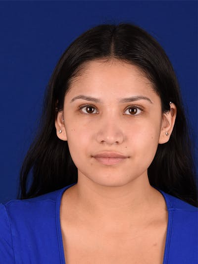 Female Rhinoplasty Before & After Gallery - Patient 115978811 - Image 2