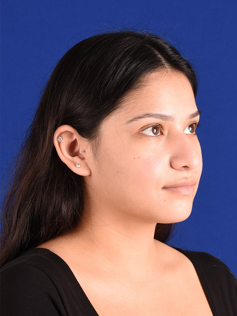 Female Rhinoplasty Before & After Gallery - Patient 115978811 - Image 3