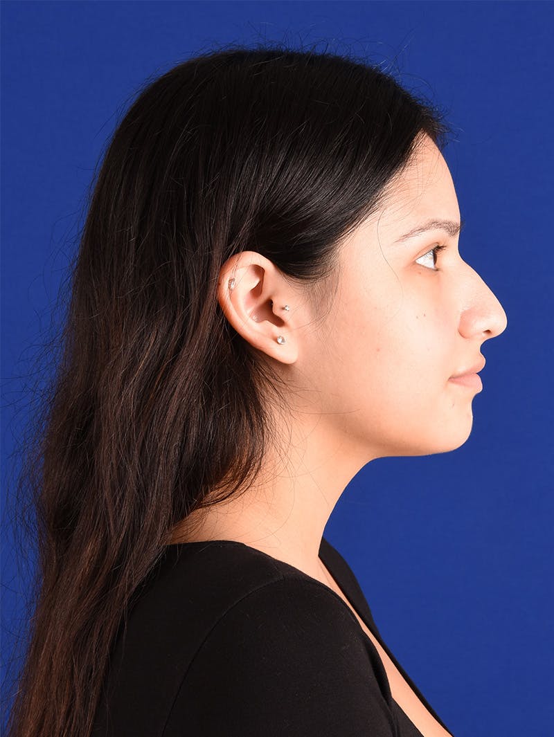 Female Rhinoplasty Before & After Gallery - Patient 115978811 - Image 5