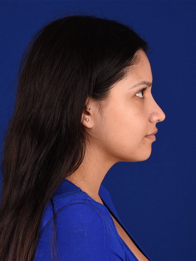 Female Rhinoplasty Before & After Gallery - Patient 115978811 - Image 6