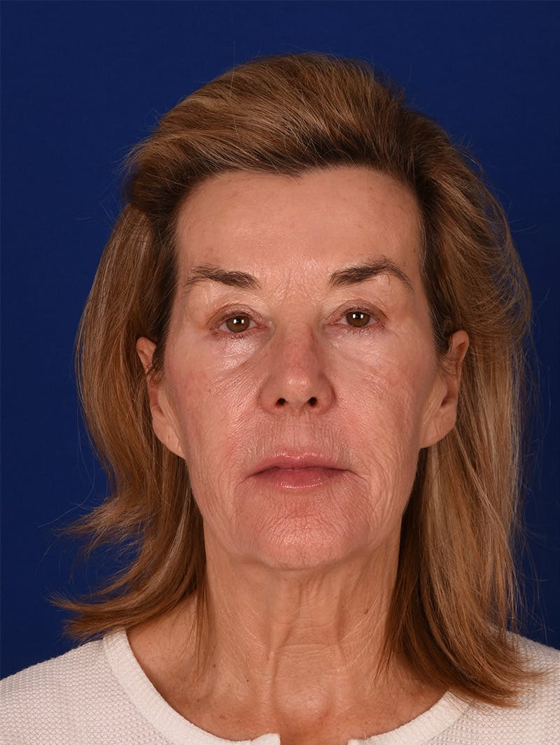 Facelift Before & After Gallery - Patient 115980061 - Image 1