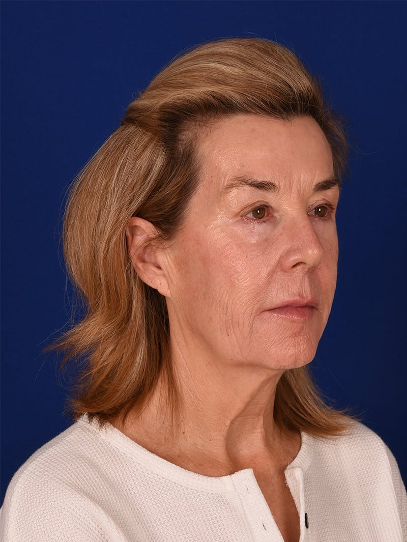 Facelift Before & After Gallery - Patient 115980061 - Image 3