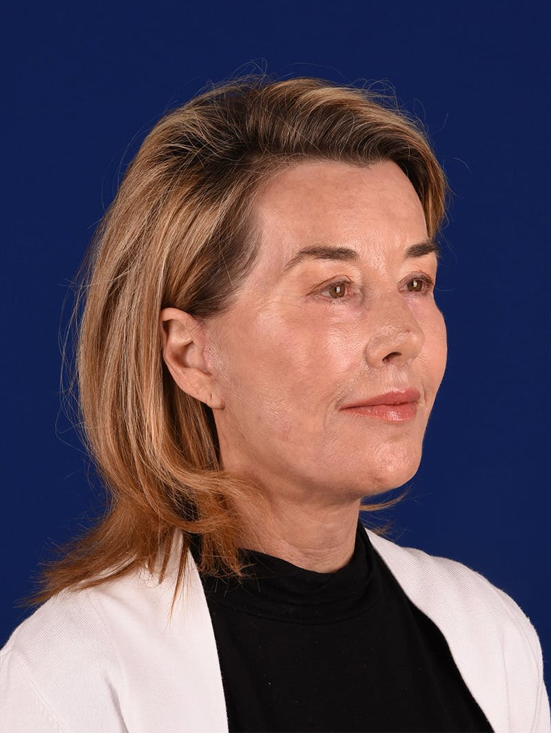 Facelift Before & After Gallery - Patient 115980061 - Image 4