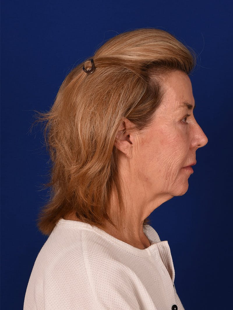 Facelift Before & After Gallery - Patient 115980061 - Image 5