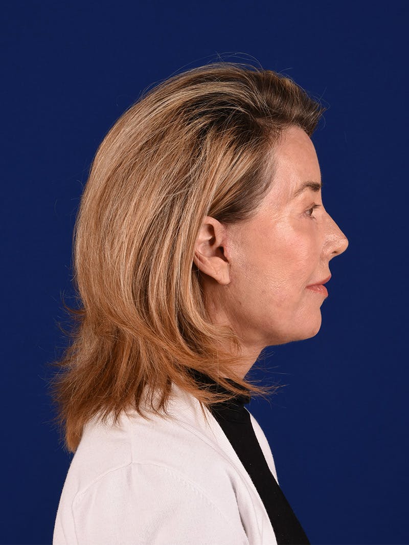 Facelift Before & After Gallery - Patient 115980061 - Image 6