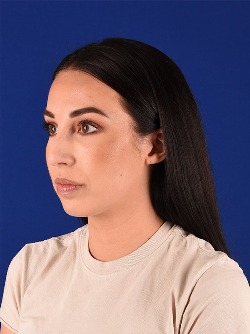 Female Rhinoplasty Before & After Gallery - Patient 122142390 - Image 3