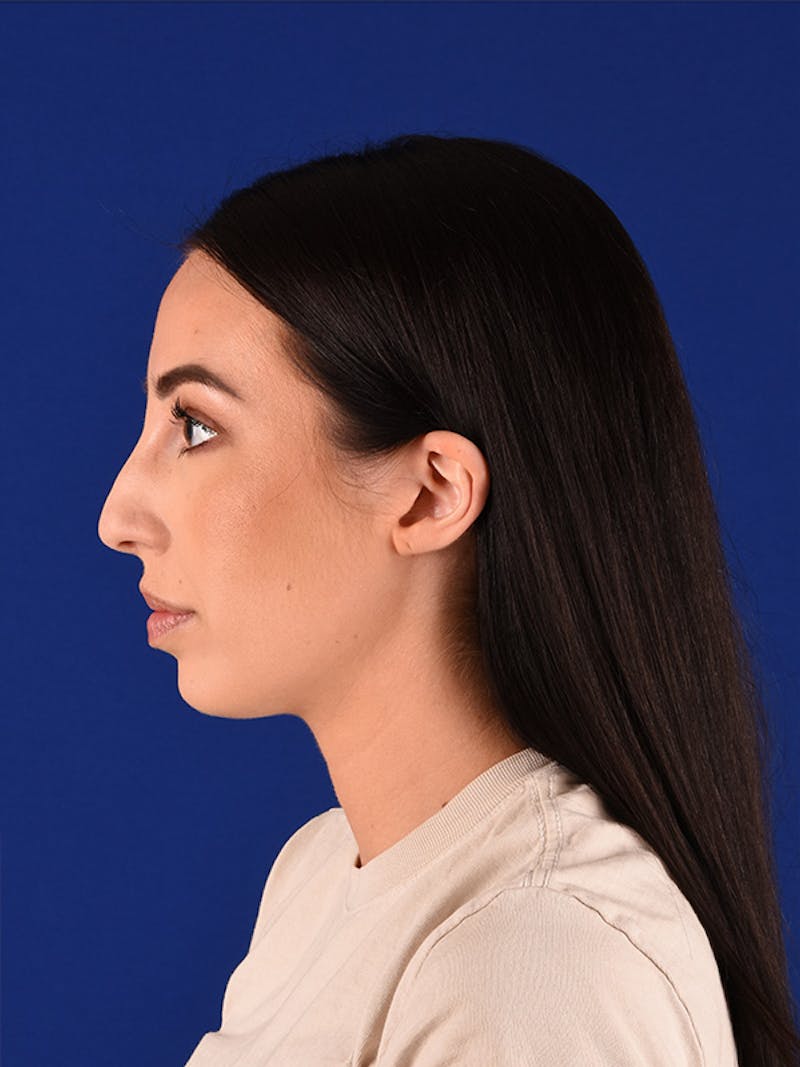Female Rhinoplasty Before & After Gallery - Patient 122142390 - Image 5
