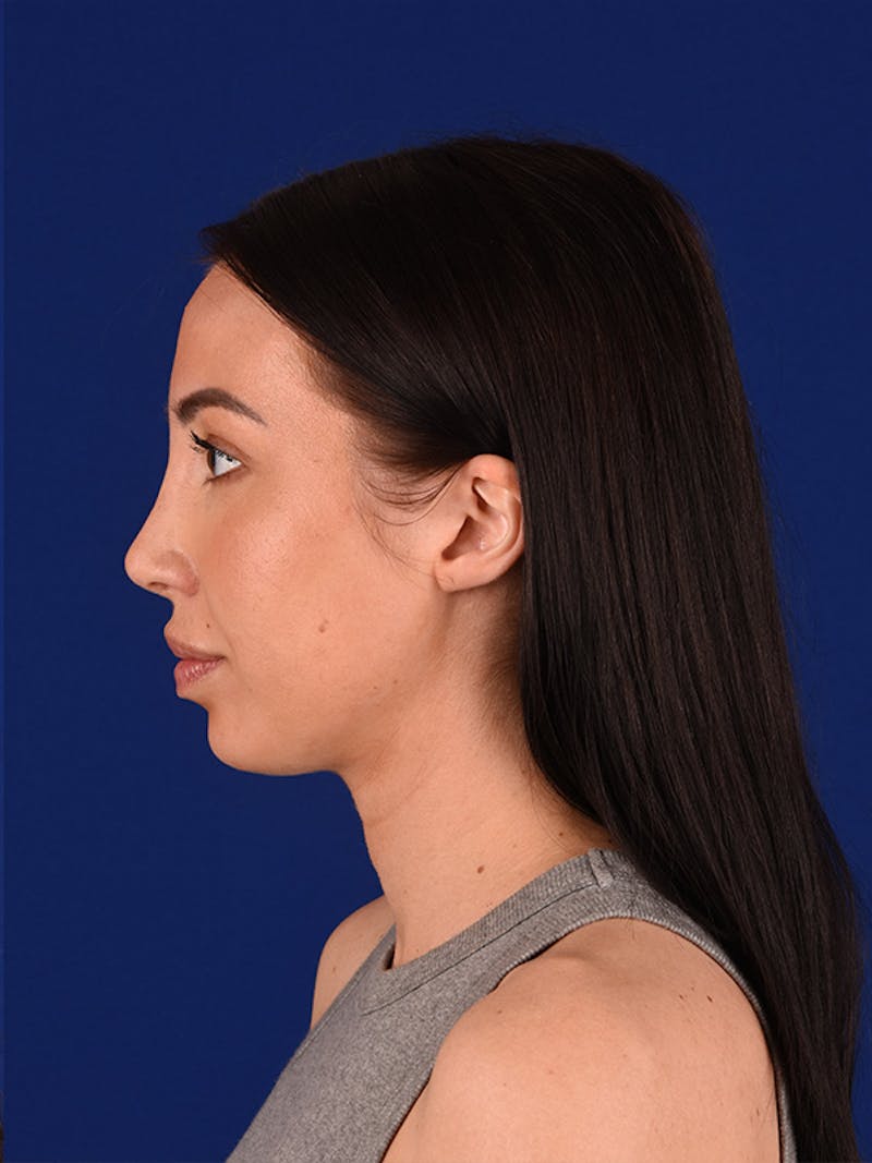 Female Rhinoplasty Before & After Gallery - Patient 122142390 - Image 6