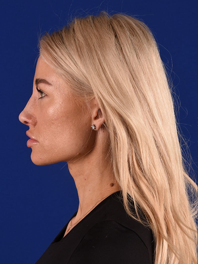 Female Rhinoplasty Before & After Gallery - Patient 122143380 - Image 4