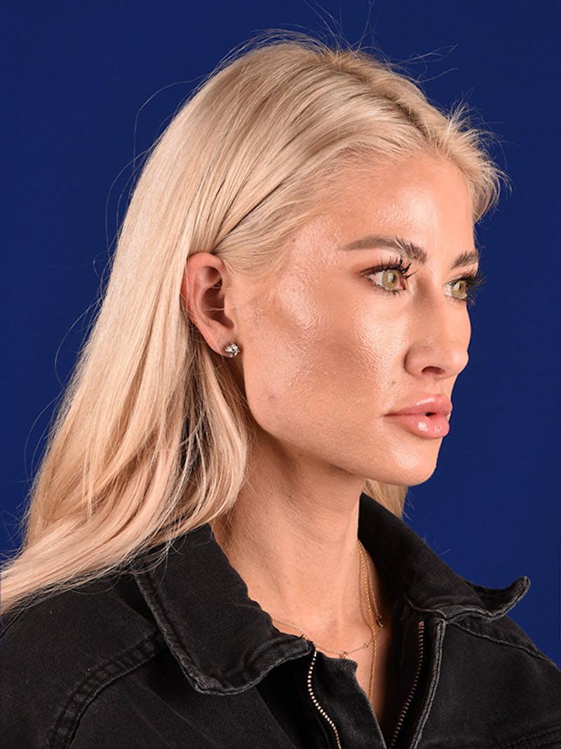 Female Rhinoplasty Before & After Gallery - Patient 122143380 - Image 7