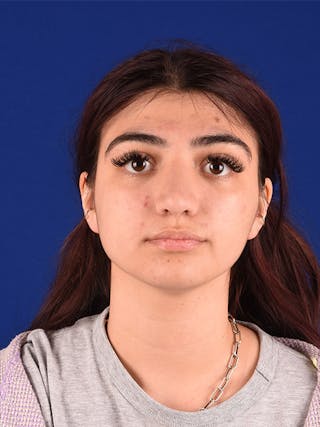 Female Rhinoplasty Before & After Gallery - Patient 122143404 - Image 2