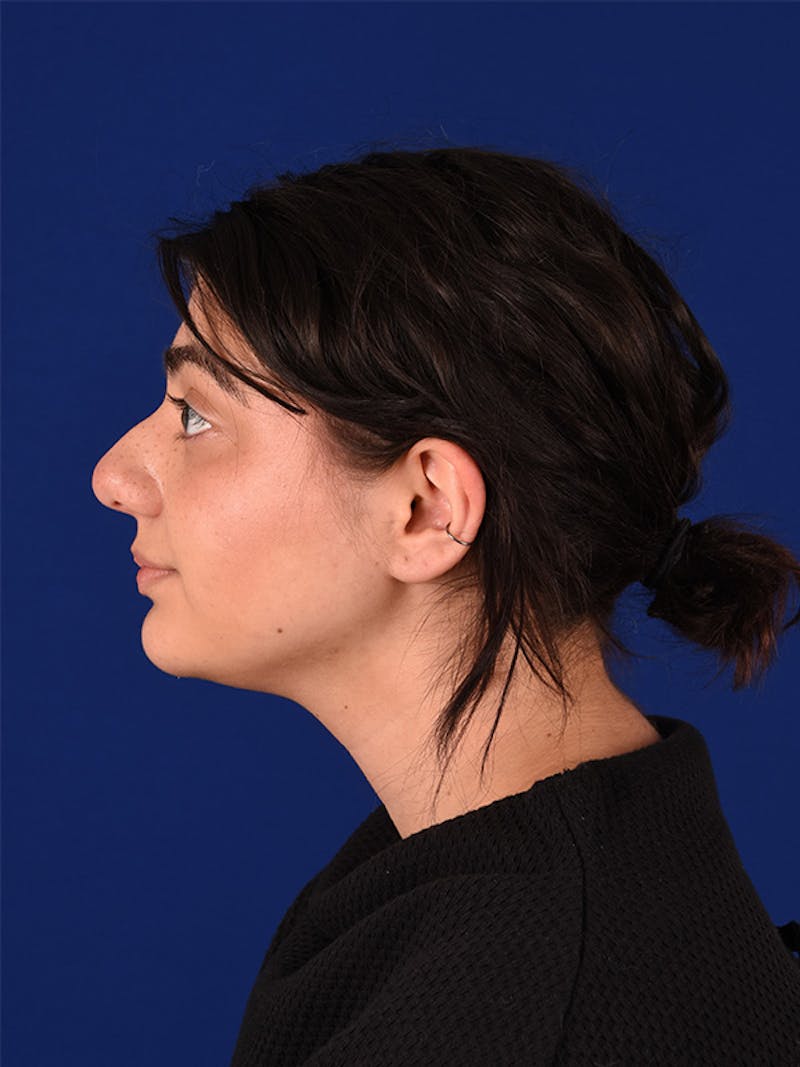 Female Rhinoplasty Before & After Gallery - Patient 122143404 - Image 3