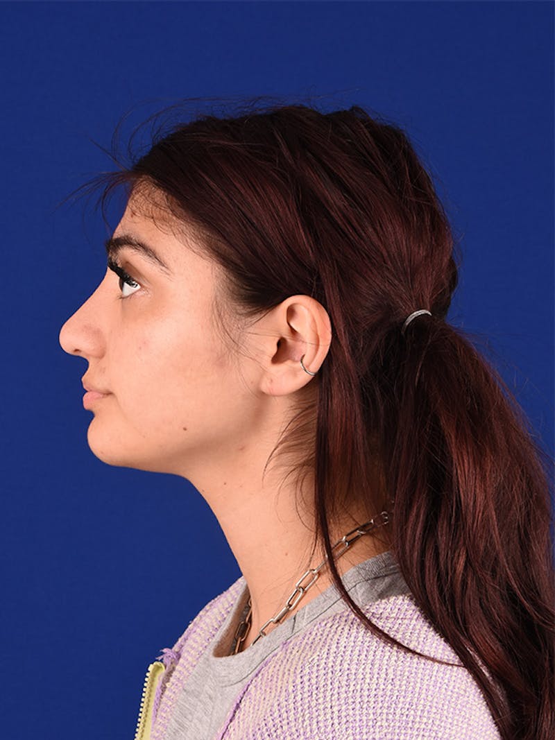 Female Rhinoplasty Before & After Gallery - Patient 122143404 - Image 4
