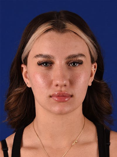 Female Rhinoplasty Before & After Gallery - Patient 122143424 - Image 1