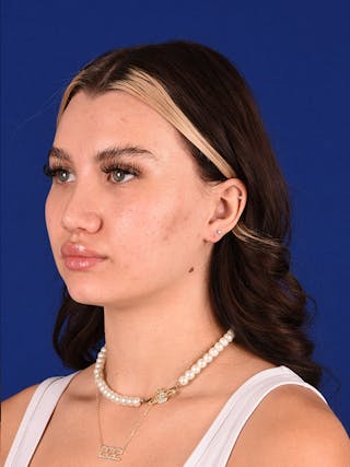 Female Rhinoplasty Before & After Gallery - Patient 122143424 - Image 4