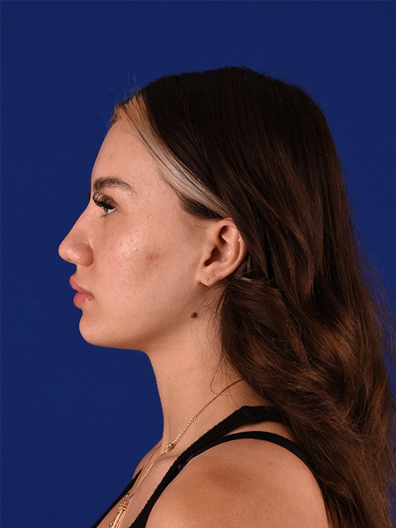 Female Rhinoplasty Before & After Gallery - Patient 122143424 - Image 5