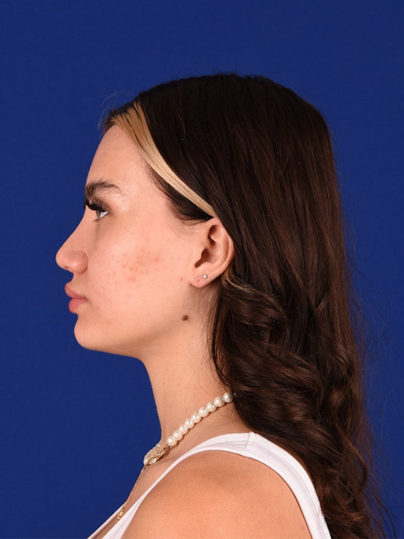 Female Rhinoplasty Before & After Gallery - Patient 122143424 - Image 6