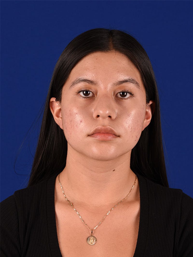 Female Rhinoplasty Before & After Gallery - Patient 122143467 - Image 1