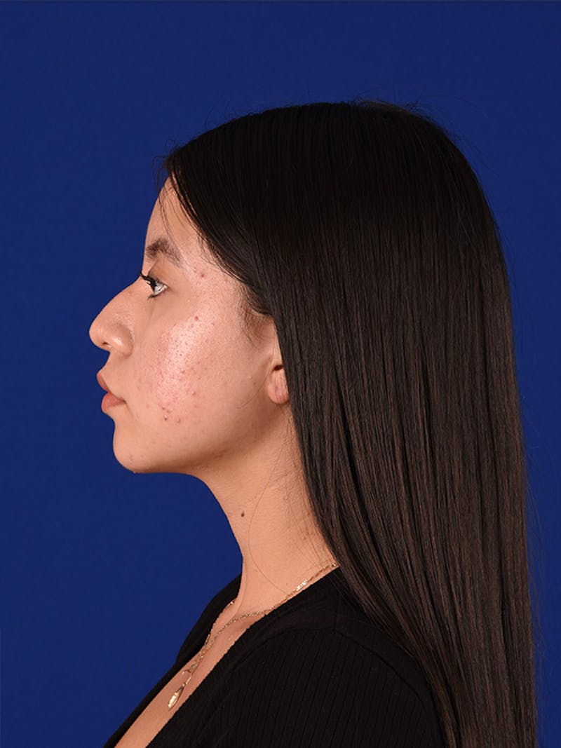 Female Rhinoplasty Before & After Gallery - Patient 122143467 - Image 5