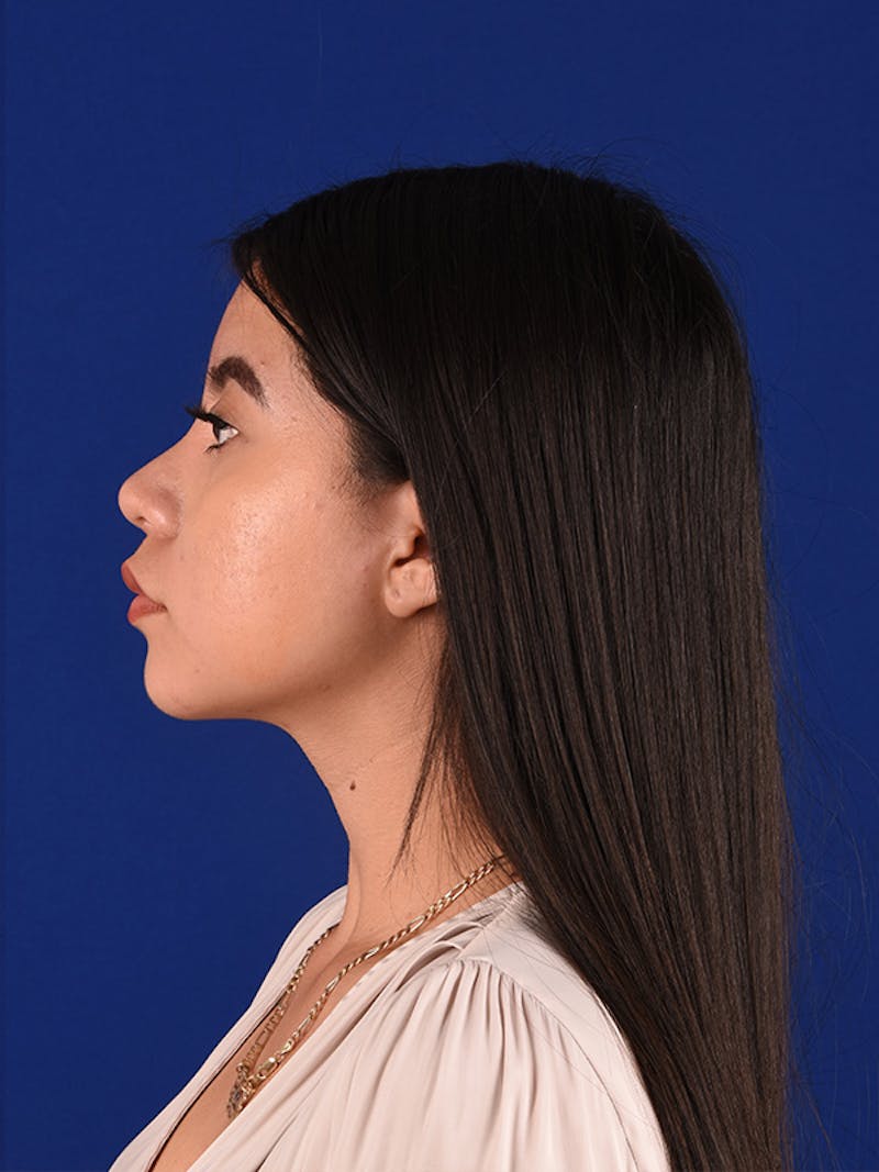 Female Rhinoplasty Before & After Gallery - Patient 122143467 - Image 6