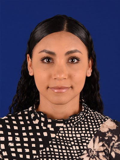 Female Rhinoplasty Before & After Gallery - Patient 122143466 - Image 1