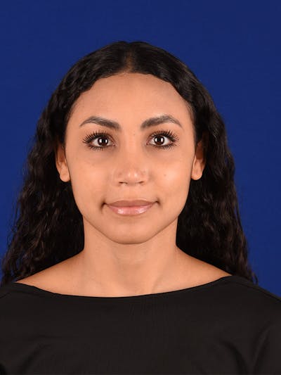 Female Rhinoplasty Before & After Gallery - Patient 122143466 - Image 2