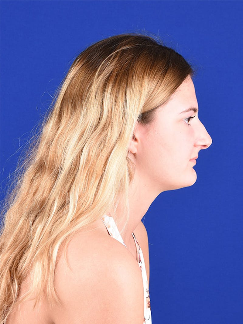 Female Rhinoplasty Before & After Gallery - Patient 122143485 - Image 5