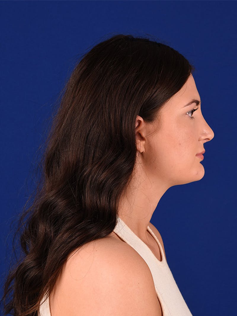 Female Rhinoplasty Before & After Gallery - Patient 122143485 - Image 6
