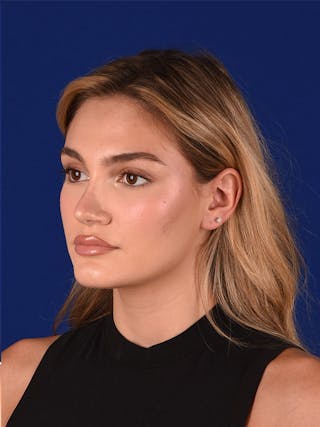 Female Rhinoplasty Before & After Gallery - Patient 122143536 - Image 4