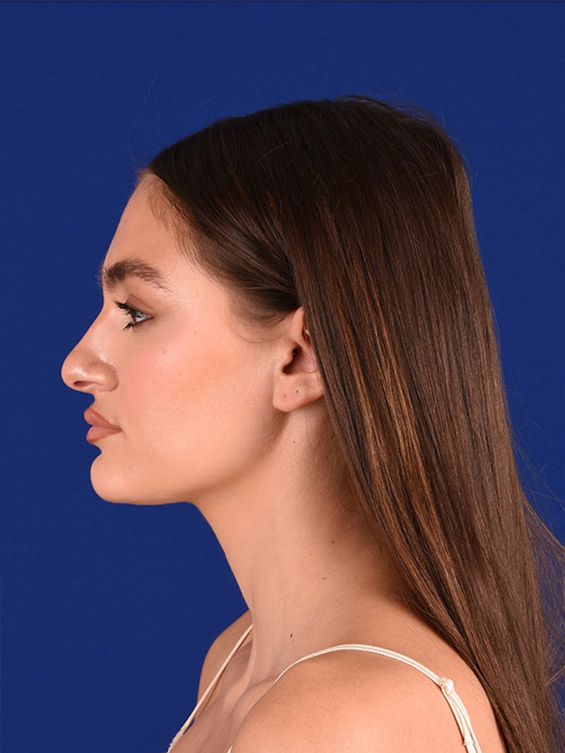 Female Rhinoplasty Before & After Gallery - Patient 122143536 - Image 5