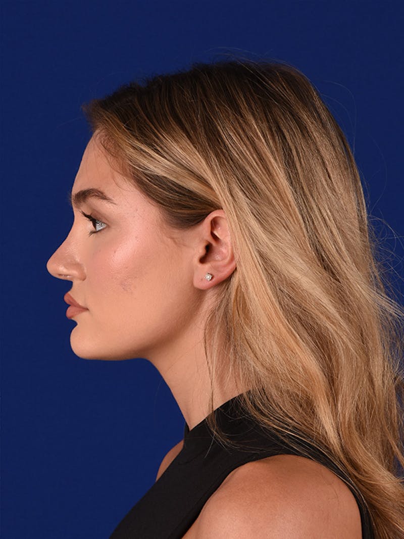 Female Rhinoplasty Before & After Gallery - Patient 122143536 - Image 6