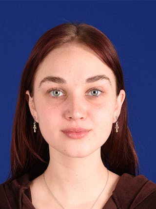 Female Rhinoplasty Before & After Gallery - Patient 122143585 - Image 2