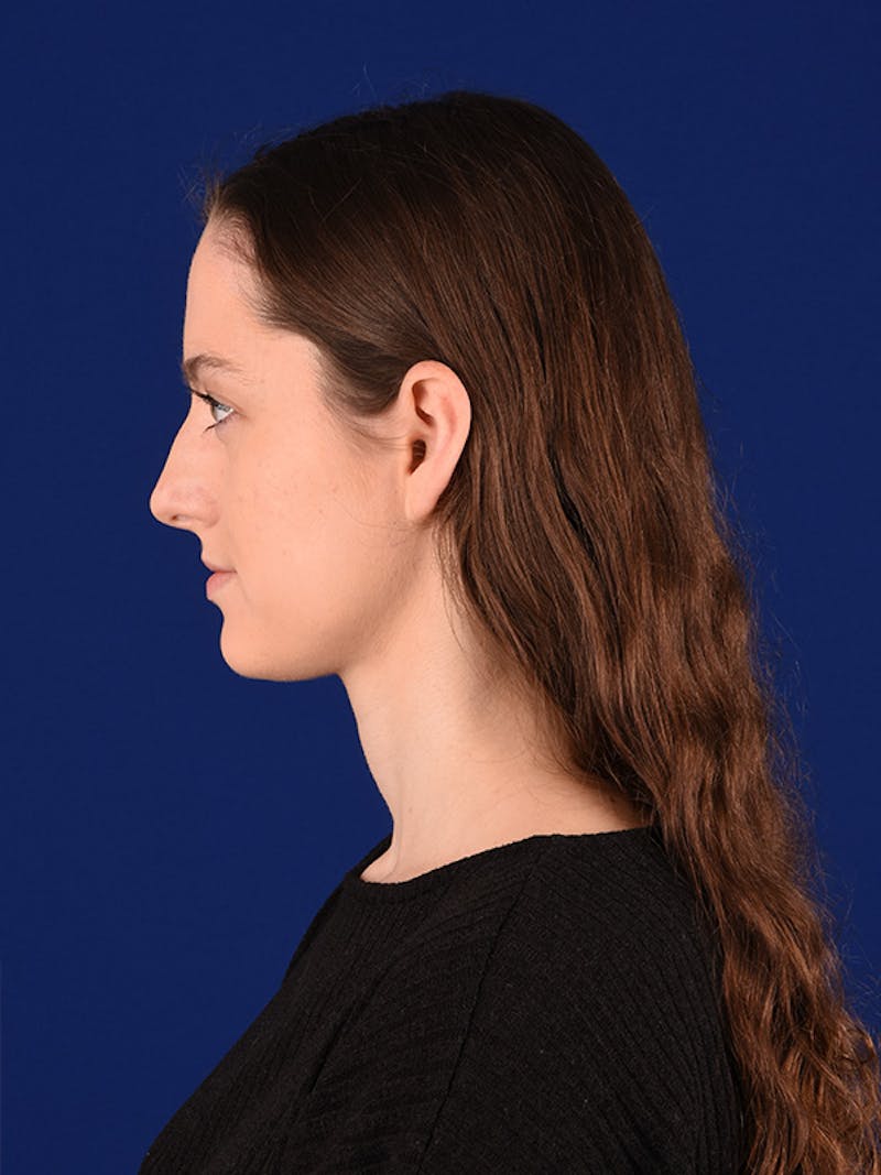 Female Rhinoplasty Before & After Gallery - Patient 122143630 - Image 5