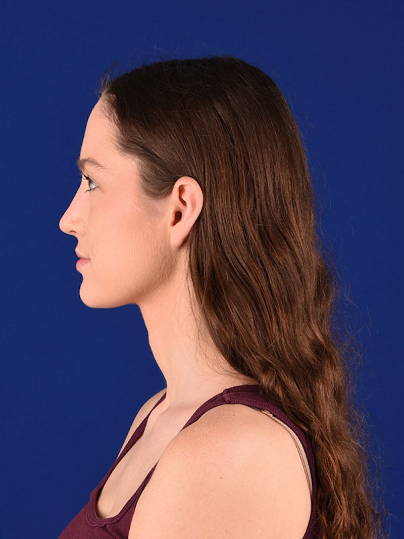 Female Rhinoplasty Before & After Gallery - Patient 122143630 - Image 6