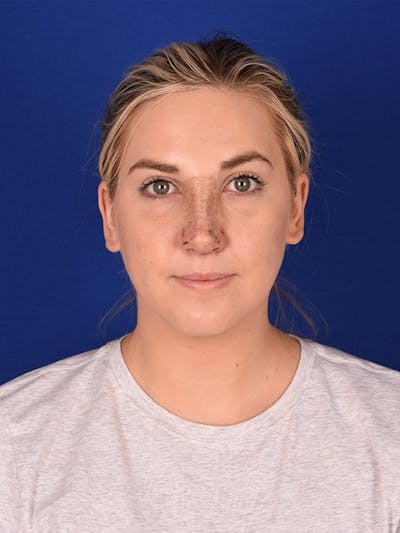 Female Rhinoplasty Before & After Gallery - Patient 122143757 - Image 2