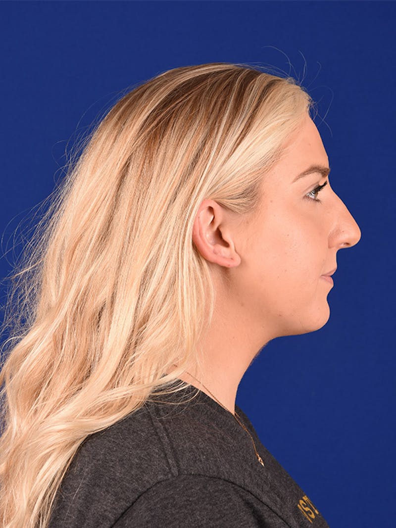 Female Rhinoplasty Before & After Gallery - Patient 122143757 - Image 3
