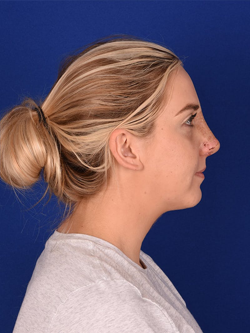 Female Rhinoplasty Before & After Gallery - Patient 122143757 - Image 4