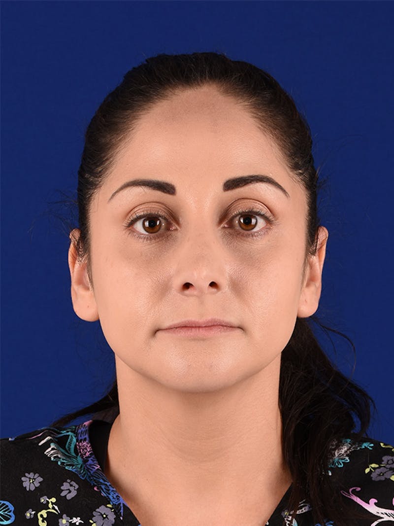 Female Rhinoplasty Before & After Gallery - Patient 122143756 - Image 1