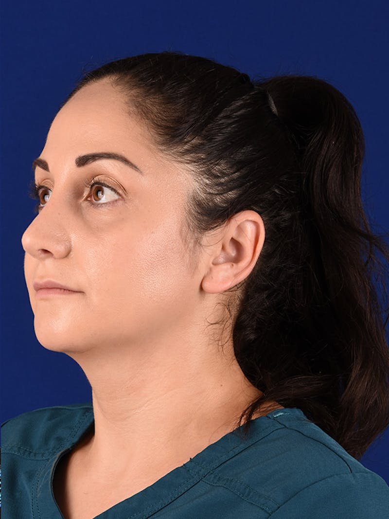 Female Rhinoplasty Before & After Gallery - Patient 122143756 - Image 4