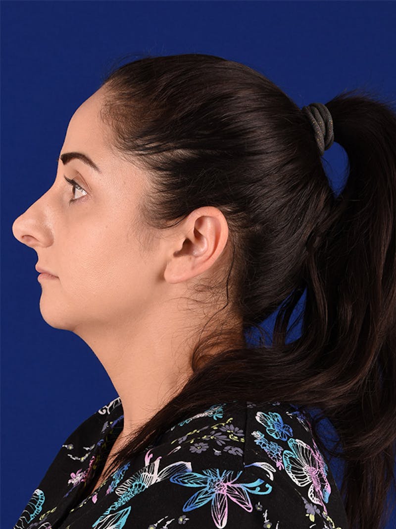 Female Rhinoplasty Before & After Gallery - Patient 122143756 - Image 5