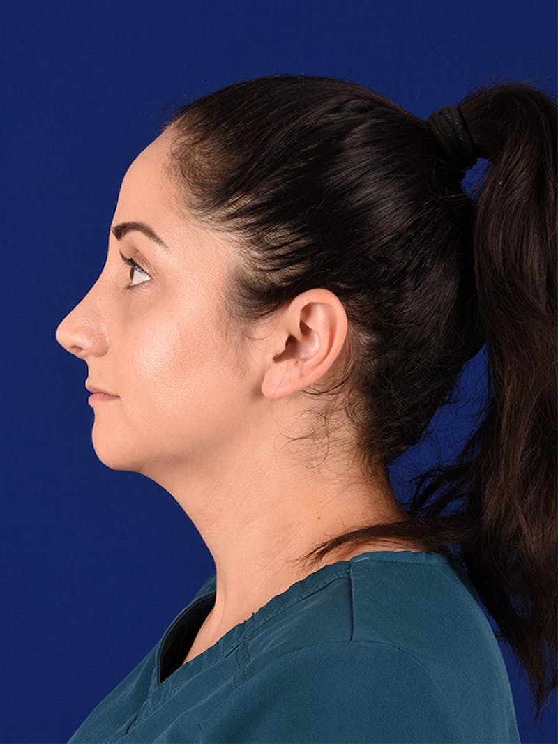 Female Rhinoplasty Before & After Gallery - Patient 122143756 - Image 6