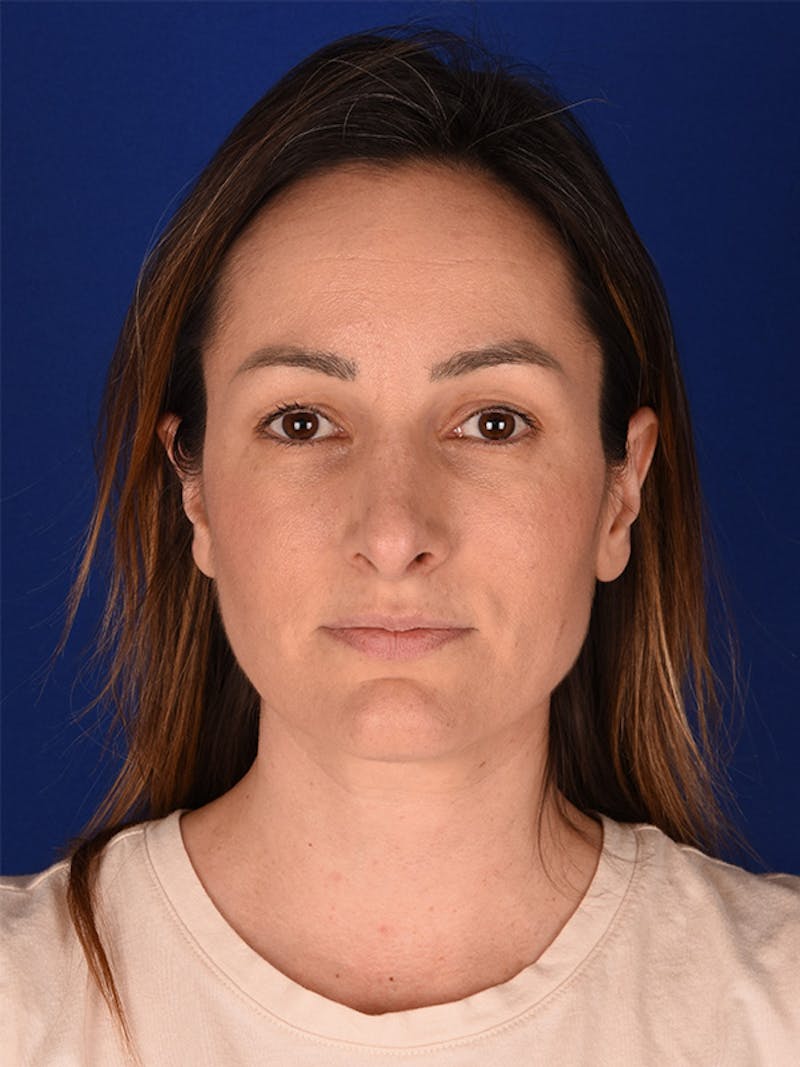 Female Rhinoplasty Before & After Gallery - Patient 122143797 - Image 1