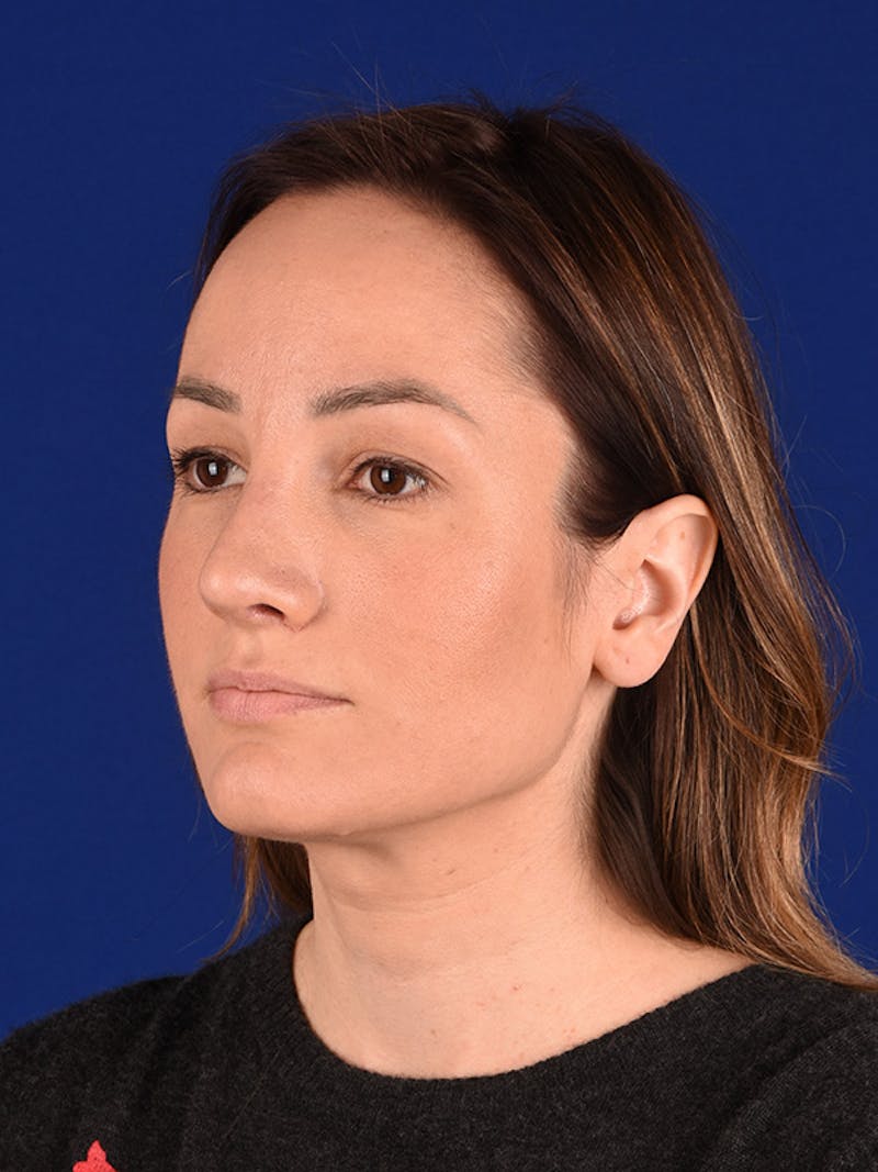 Female Rhinoplasty Before & After Gallery - Patient 122143797 - Image 4